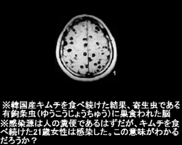 韓国産キムチを食べ続けた結果、寄生虫である有鉤条虫(ゆうこうじょうちゅう)に巣食われた脳。感染源は人の糞便であるはずだが、キムチを食べ続けた21歳女性は感染した。この意味がわかるだろうか?